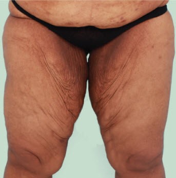 dr-adjei-plastic-surgery-body-thigh-lift-2
