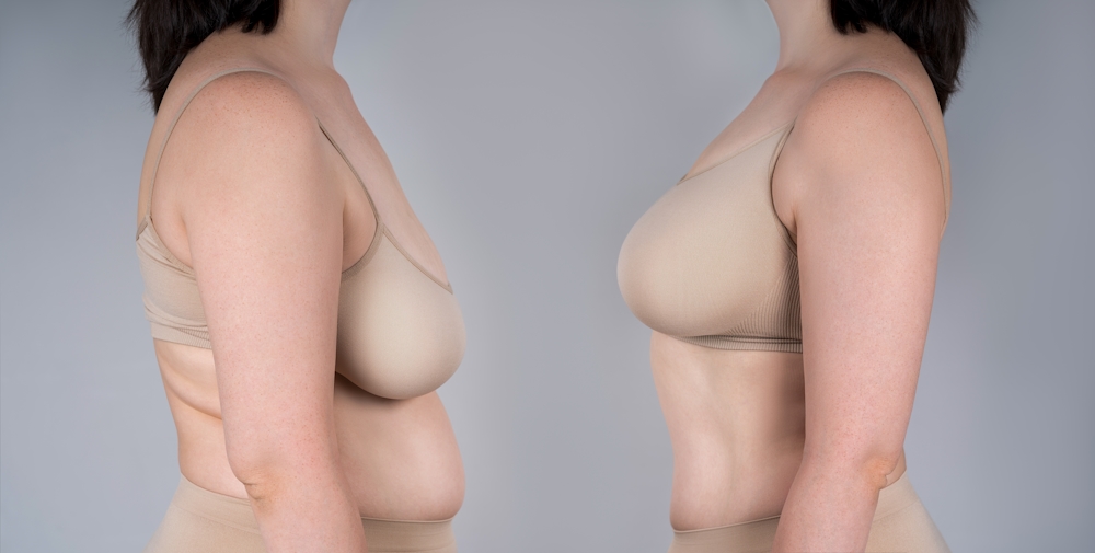 Before and after breast augmentation concept, woman with very large silicone breasts after correction surgery on gray background